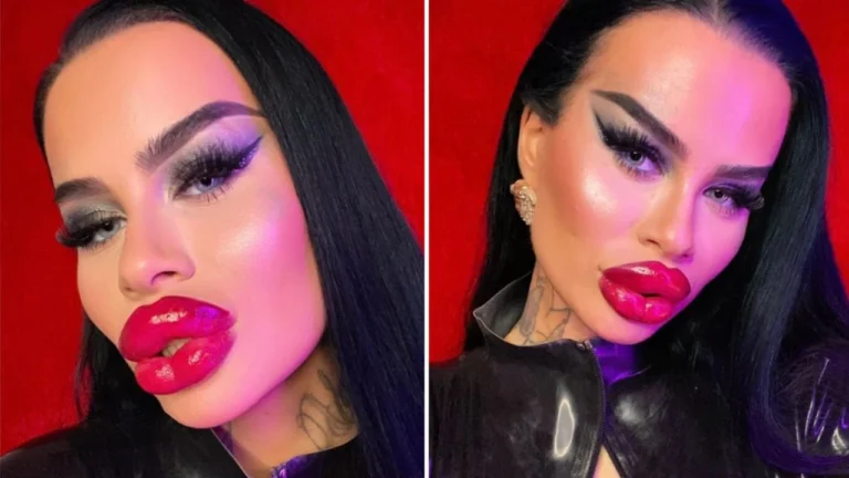 newslove.com Fetish Barbie, an Austrian OnlyFans model, spends £50,000 to get her lips drastically plumped I'm obsessed with plastic surgery.